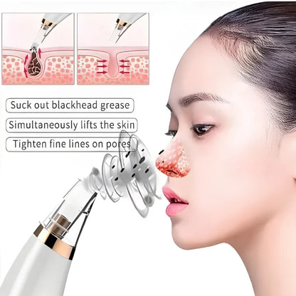 Professional Skin Refiner, Blackhead Remover, Pore Therapy (5 in 1)