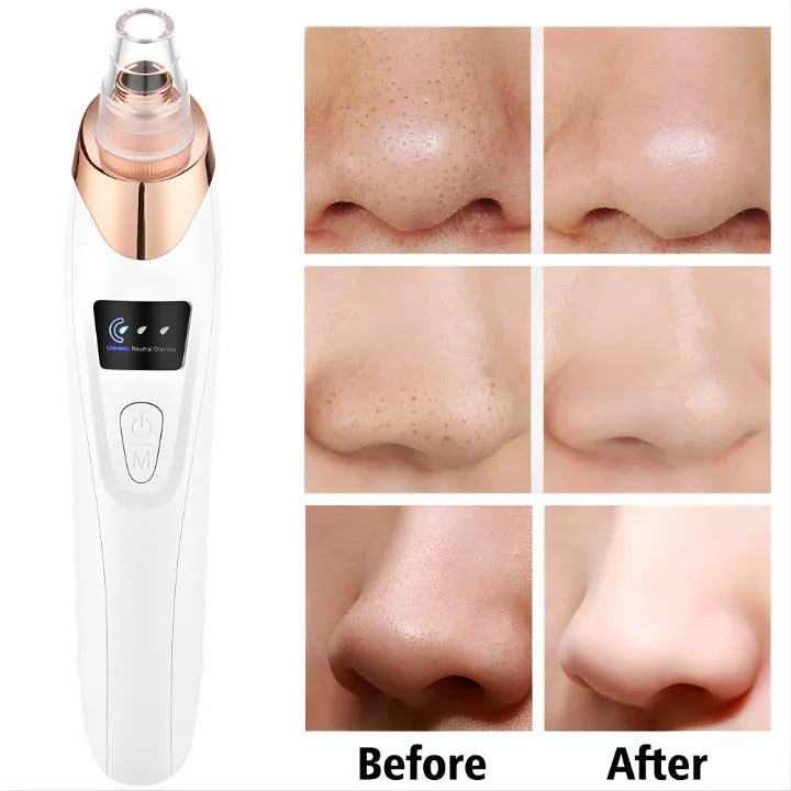 Professional Skin Refiner, Blackhead Remover, Pore Therapy (5 in 1)