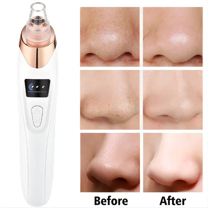 Professional Skin Refiner, Blackhead Remover, Pore Therapy (5 in 1)